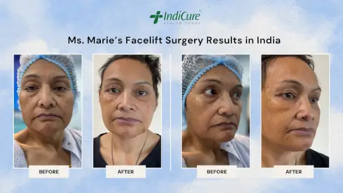 New Zealander's Facelift Surgery Results in India